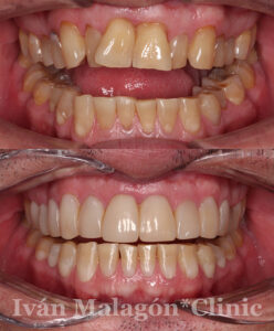 Aspecto de la dentadura del paciente antes y después del tratamiento con Invisalign.