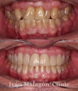 Imagen intraoral de la dentadura del paciente antes y después del tratamiento con invisalign.