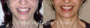 Comparativa de la sonrisa de la paciente antes y después de utilizar Invisalign