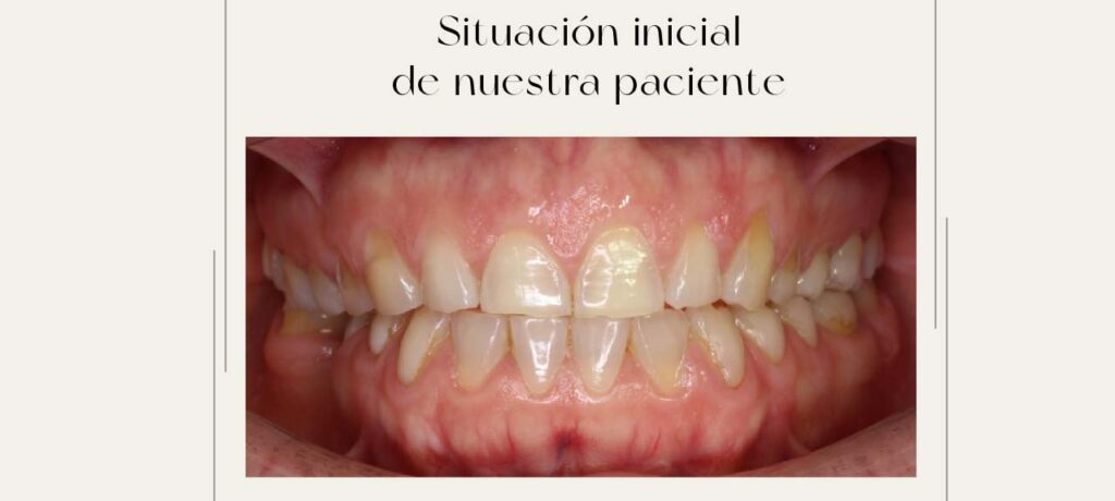 mordida estrecha solucionada con ortodoncia invisible 